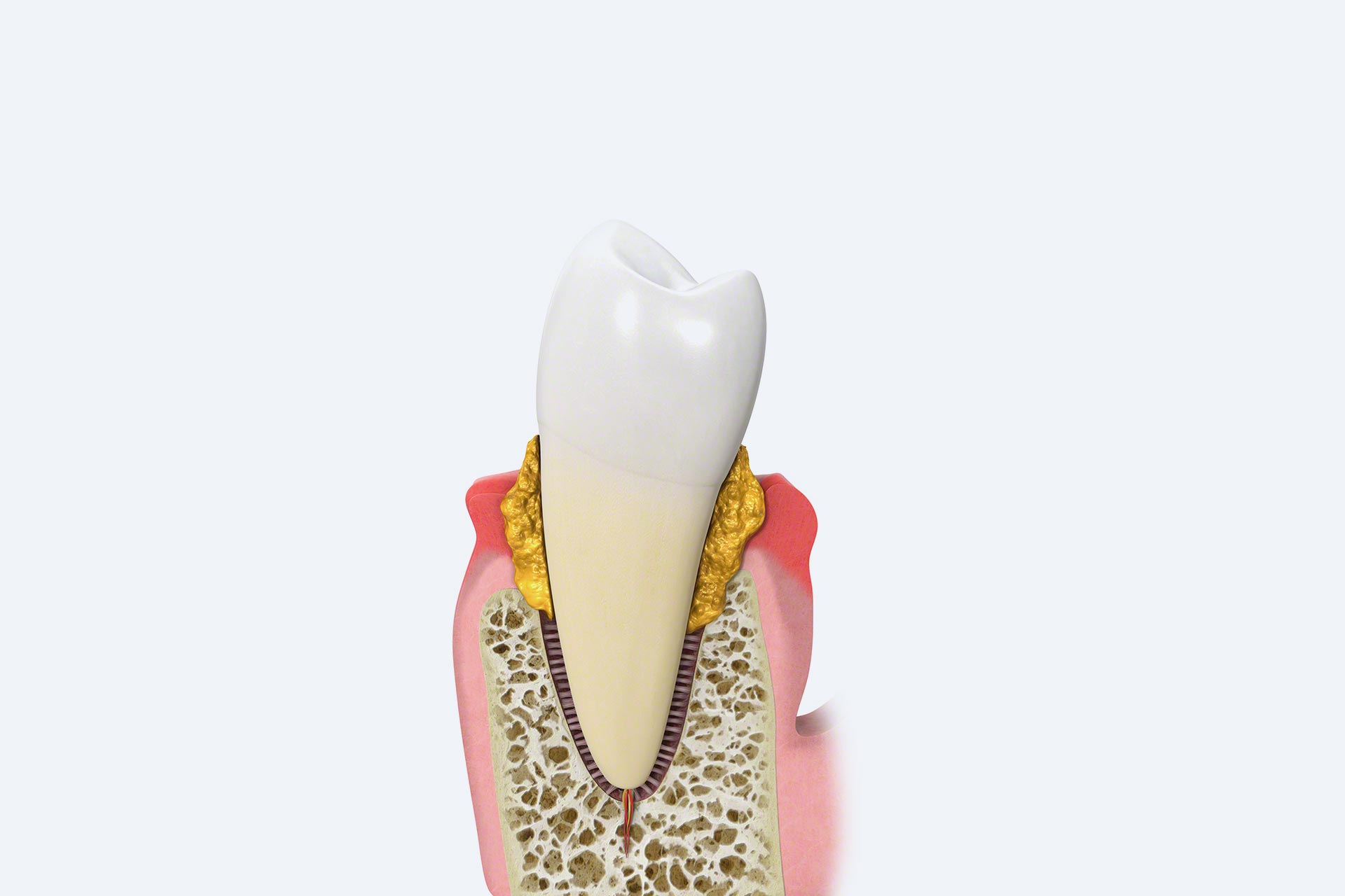 Parodontitis Behandlung Zahnarzt